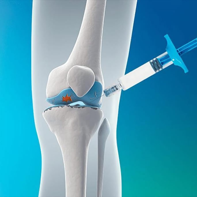 viscosupplementation-melbourne-arthritic-knee-treatment